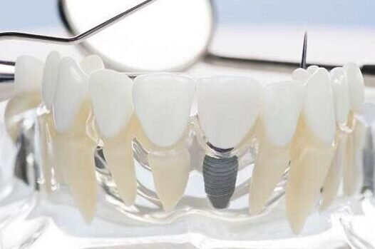 dental Implant treatment