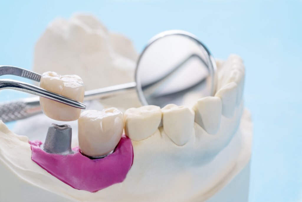 dental crowns and caps