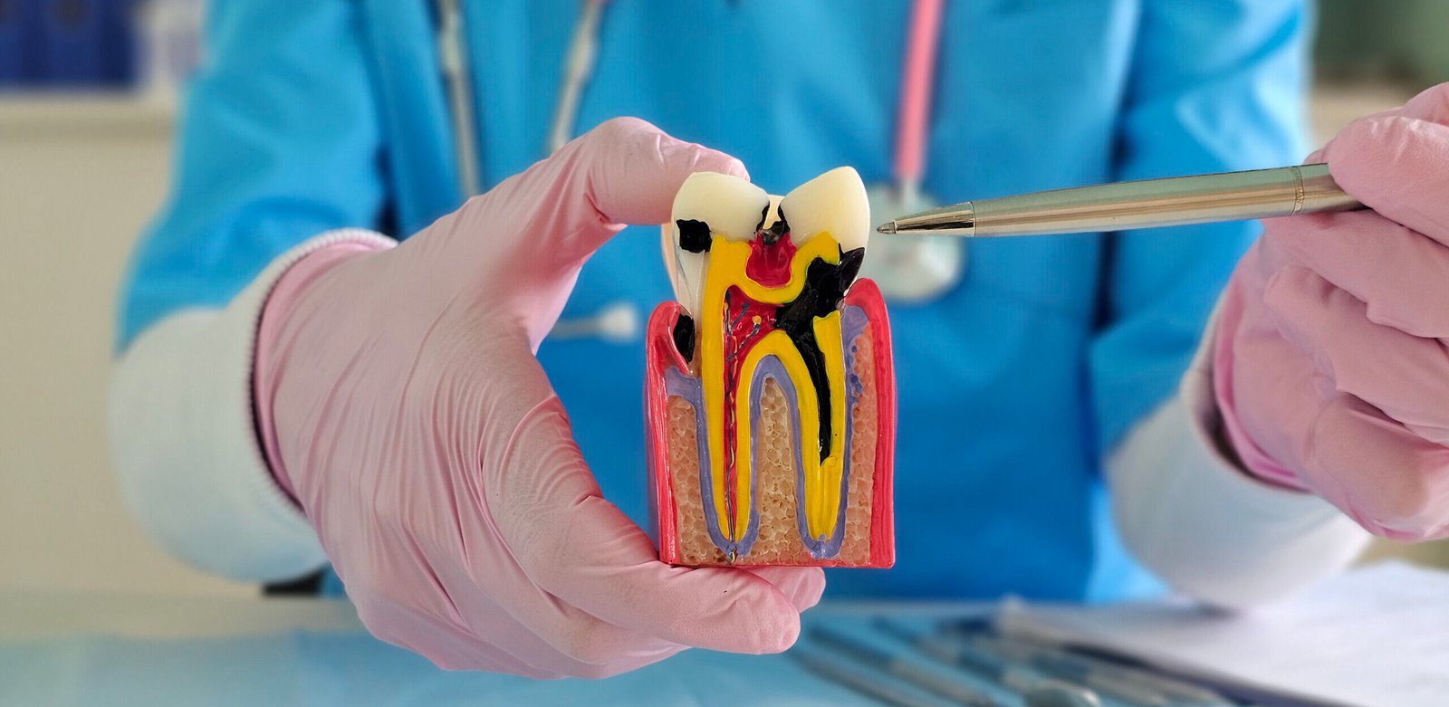 laser root canal treatment