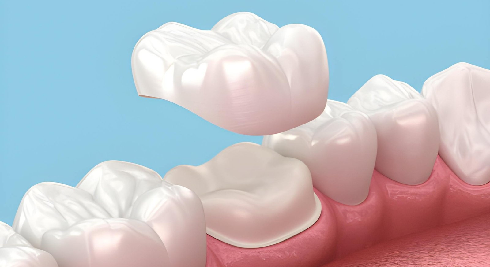 dental crowns and caps