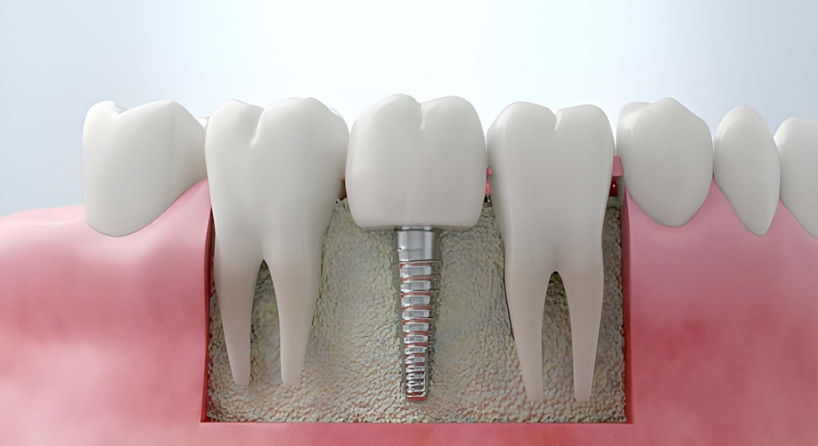dental Implant treatment