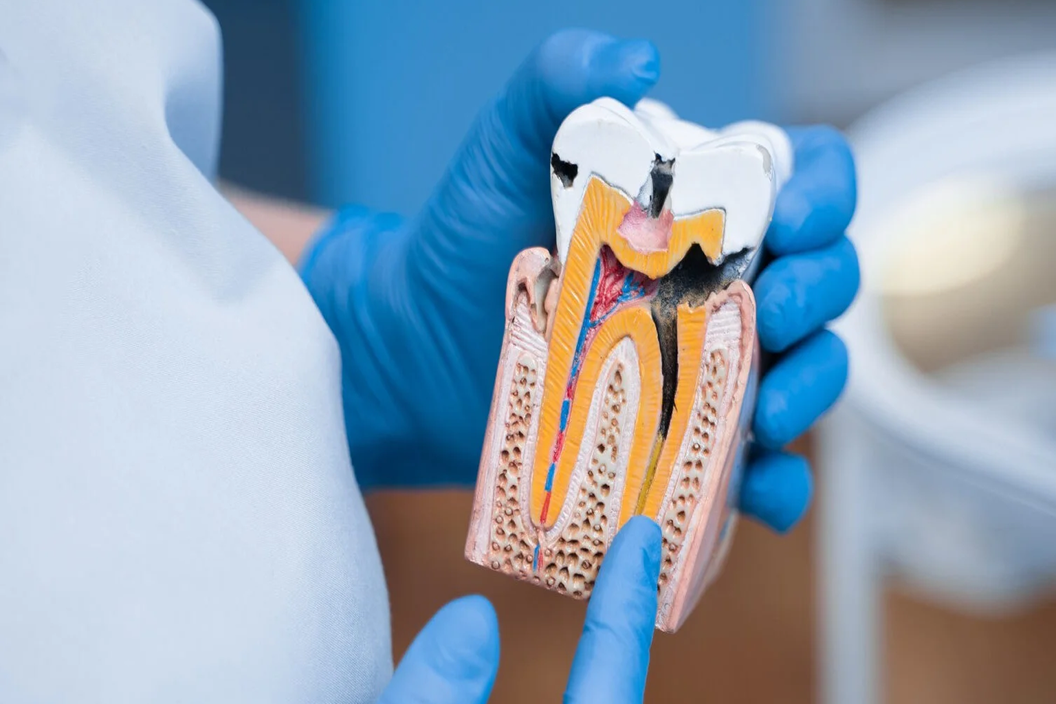 laser root canal treatment